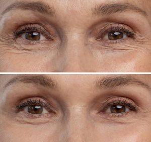 tratamiento-belleza-antienvejecimiento ojos